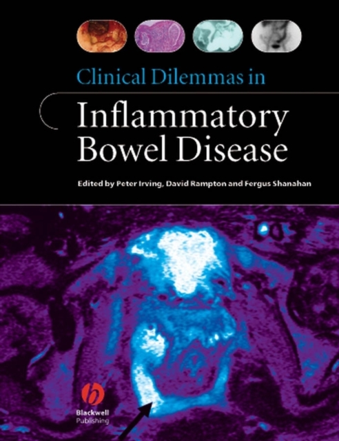Clinical Dilemmas in Inflammatory Bowel Disease, PDF eBook
