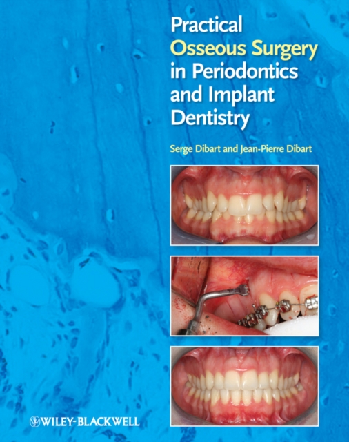 Practical Osseous Surgery in Periodontics and Implant Dentistry, EPUB eBook