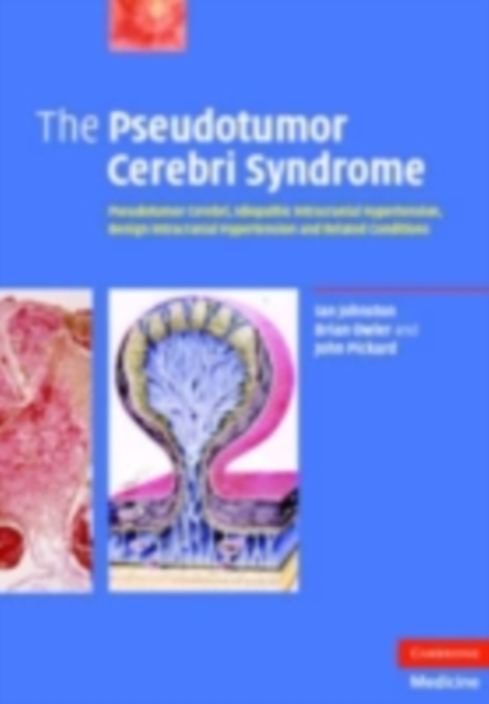 Pseudotumor Cerebri Syndrome : Pseudotumor Cerebri, Idiopathic Intracranial Hypertension, Benign Intracranial Hypertension and Related Conditions, PDF eBook
