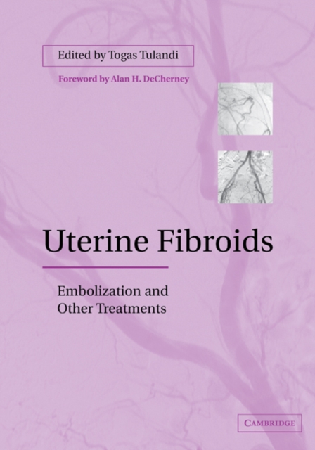 Uterine Fibroids : Embolization and other Treatments, Paperback / softback Book