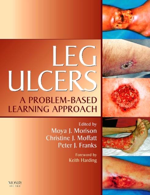 Leg Ulcers E-Book : Leg Ulcers E-Book, PDF eBook