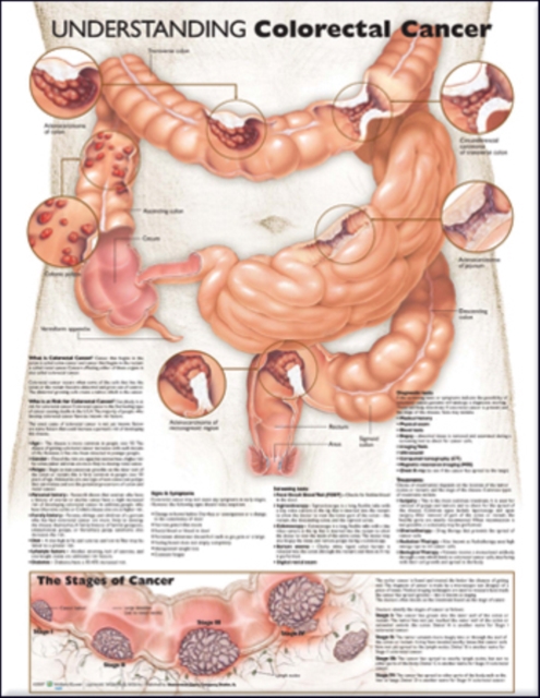 Understanding Colorectal Cancer Anatomical Chart, Wallchart Book