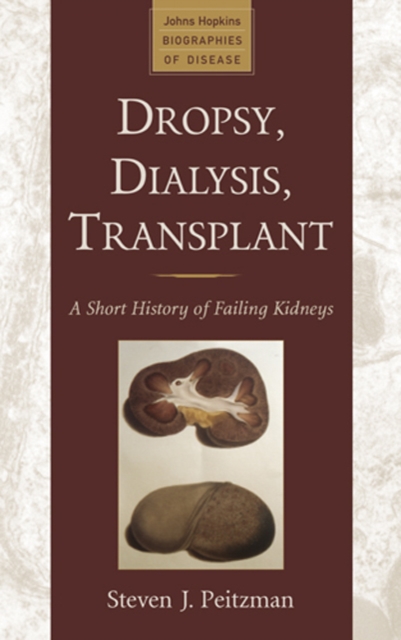 Dropsy, Dialysis, Transplant : A Short History of Failing Kidneys, Hardback Book