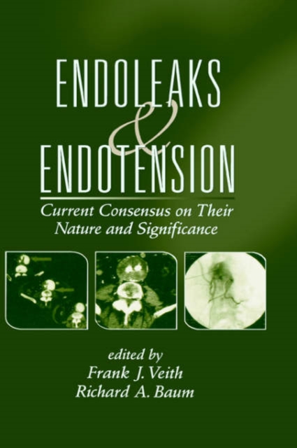 Endoleaks and Endotension : Current Consensus on Their Nature and Significance, Hardback Book