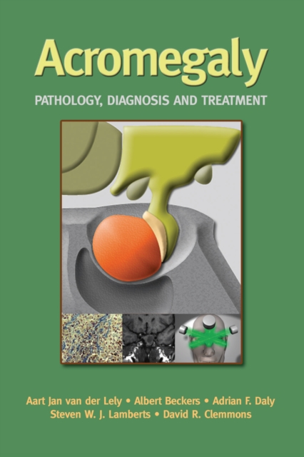 Acromegaly : Pathology, Diagnosis and Treatment, PDF eBook