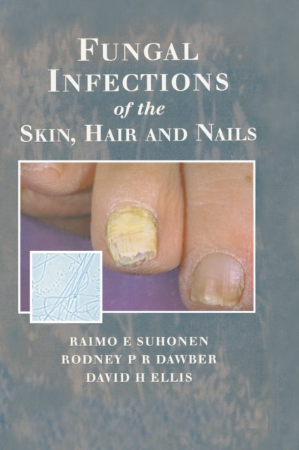 Fungal Infections of the Skin and Nails, EPUB eBook