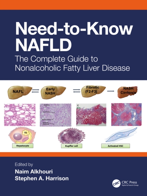 Need-to-Know NAFLD : The Complete Guide to Nonalcoholic Fatty Liver Disease, EPUB eBook