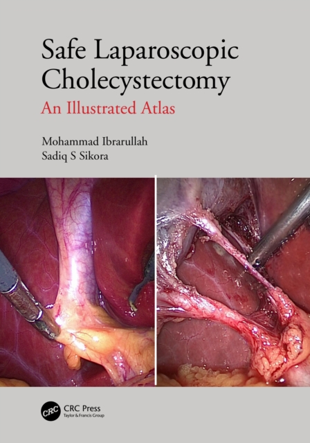 Safe Laparoscopic Cholecystectomy : An Illustrated Atlas, Hardback Book