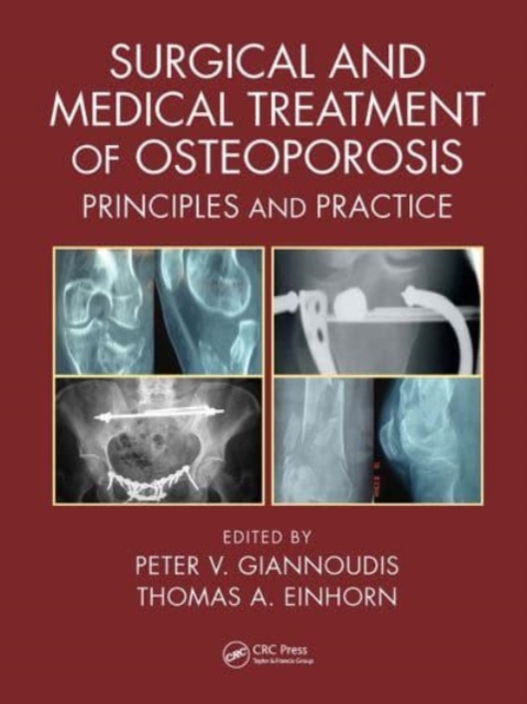 Surgical and Medical Treatment of Osteoporosis : Principles and Practice, Paperback / softback Book