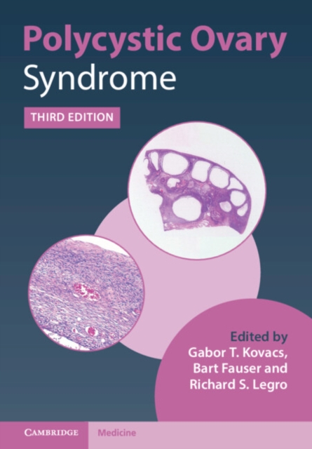 Polycystic Ovary Syndrome, Hardback Book