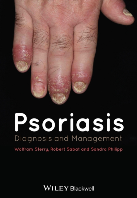 Psoriasis : Diagnosis and Management, PDF eBook
