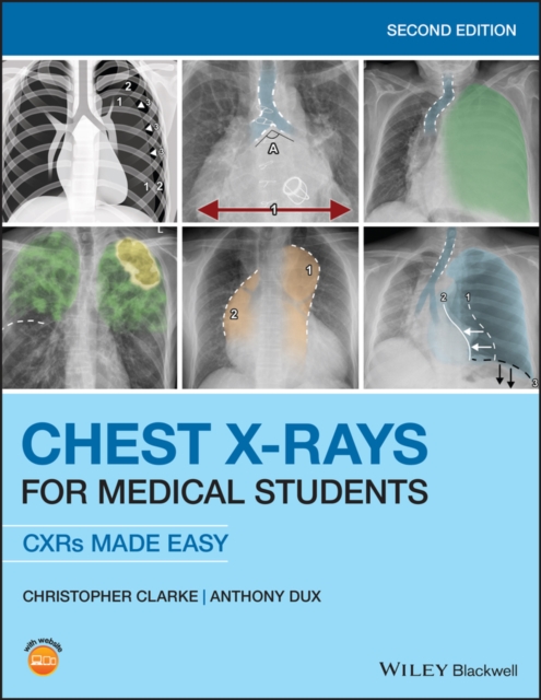 Chest X-Rays for Medical Students : CXRs Made Easy, PDF eBook
