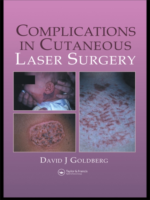 Complications in Laser Cutaneous Surgery, PDF eBook