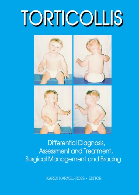 Torticollis : Differential Diagnosis, Assessment and Treatment, Surgical Management and Bracing, PDF eBook