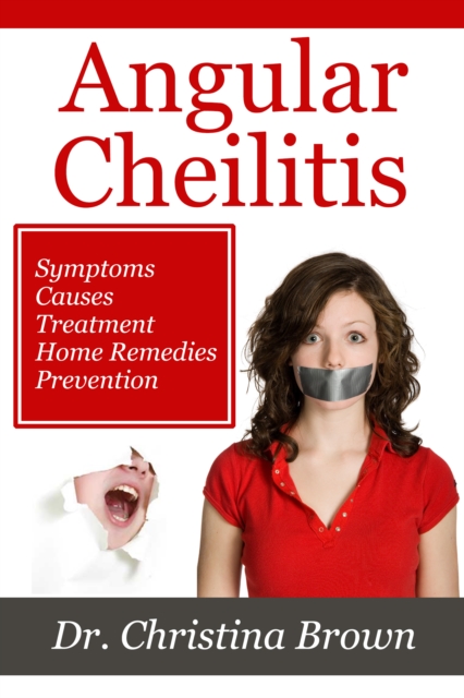 Angular Cheilitis, EPUB eBook