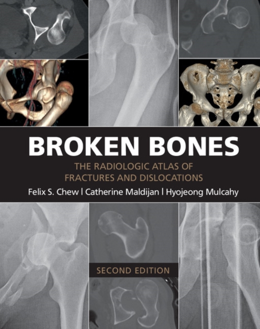 Broken Bones : The Radiologic Atlas of Fractures and Dislocations, PDF eBook