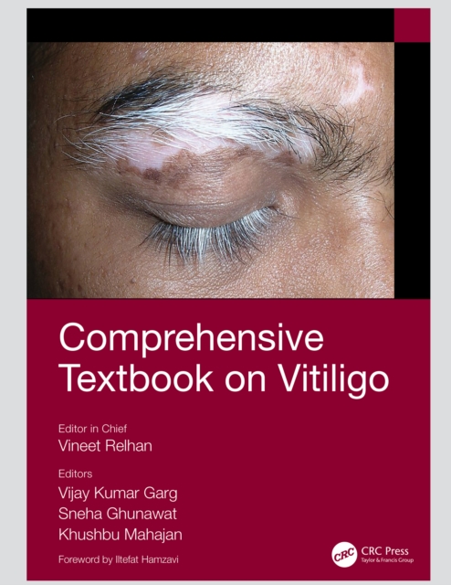Comprehensive Textbook on Vitiligo, EPUB eBook