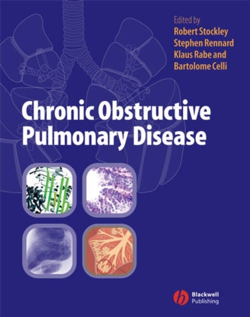 Chronic Obstructive Pulmonary Disease, Hardback Book