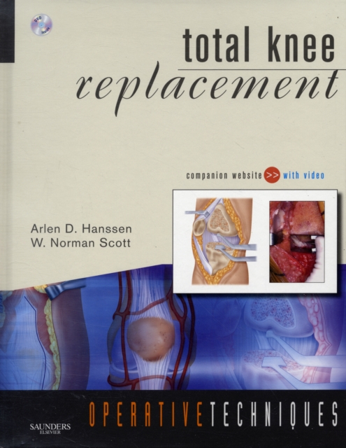 Total Knee Replacement, Mixed media product Book