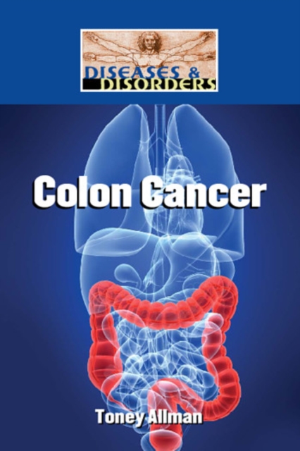 Colon Cancer, PDF eBook