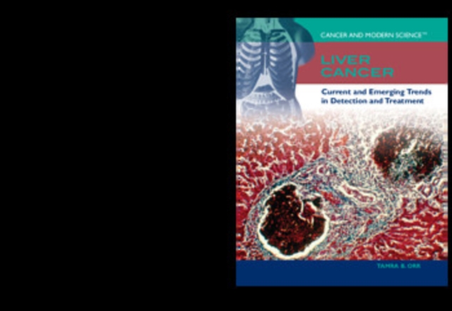 Liver Cancer, PDF eBook