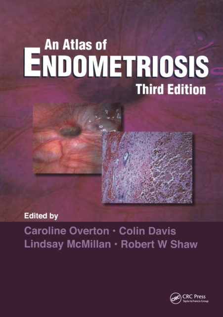Atlas of Endometriosis, PDF eBook