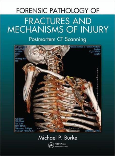 Forensic Pathology of Fractures and Mechanisms of Injury : Postmortem CT Scanning, Hardback Book