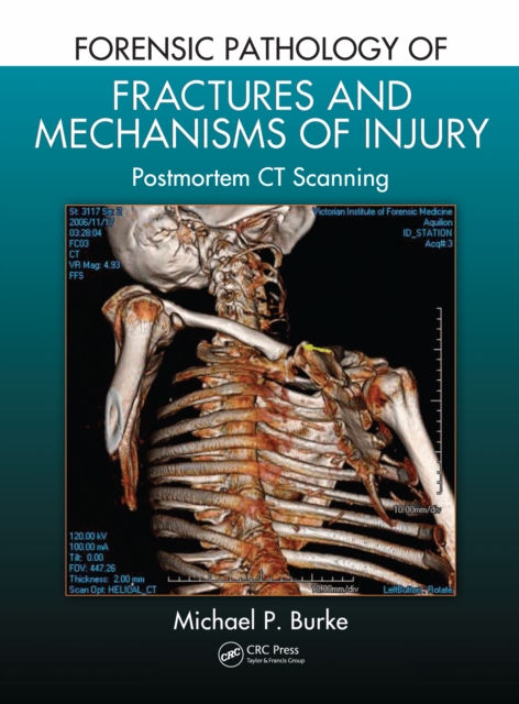 Forensic Pathology of Fractures and Mechanisms of Injury : Postmortem CT Scanning, PDF eBook