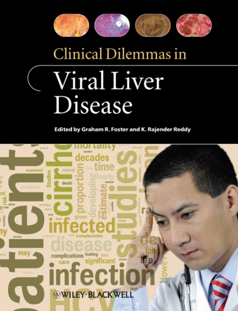 Clinical Dilemmas in Viral Liver Disease, PDF eBook