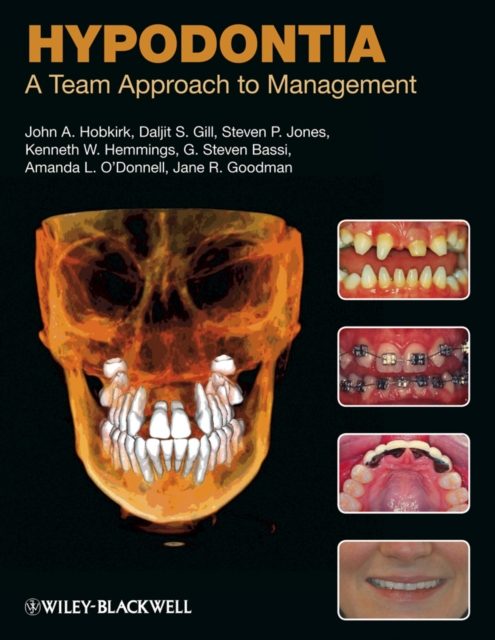 Hypodontia : A Team Approach to Management, PDF eBook
