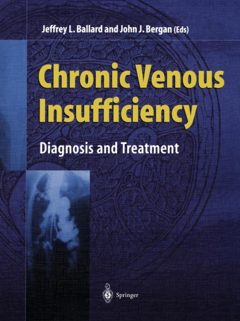 Chronic Venous Insufficiency : Diagnosis and Treatment, Paperback / softback Book