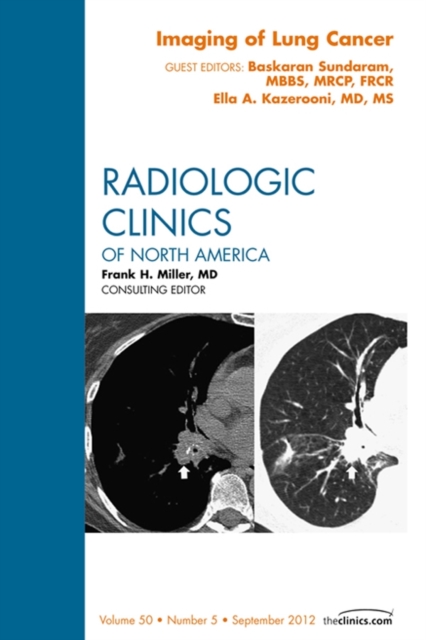 Imaging of Lung Cancer, An Issue of Radiologic Clinics of North America, EPUB eBook