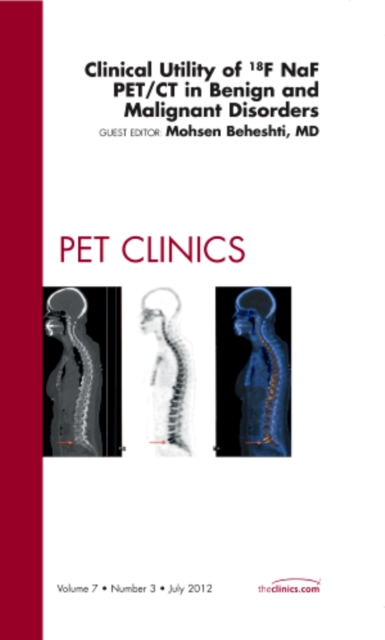 Clinical Utility of 18NaF PET/CT in Benign and Malignant Disorders, An Issue of PET Clinics : Volume 7-3, Hardback Book