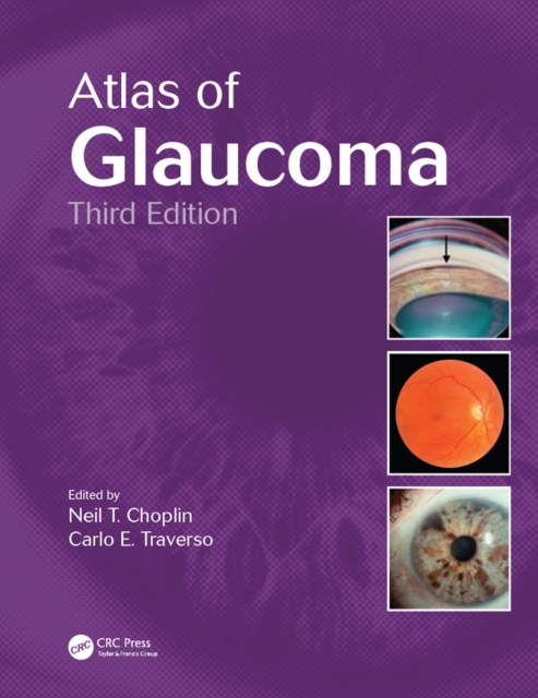 Atlas of Glaucoma, PDF eBook