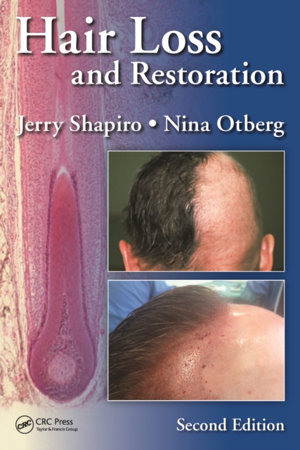 Hair Loss and Restoration, PDF eBook