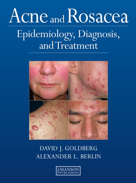 Acne and Rosacea : Epidemiology, Diagnosis and Treatment, EPUB eBook