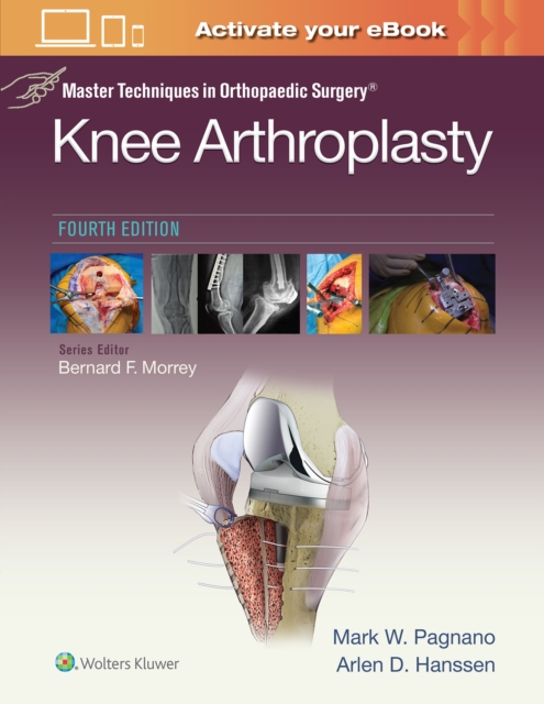 Master Techniques in Orthopedic Surgery: Knee Arthroplasty, Hardback Book