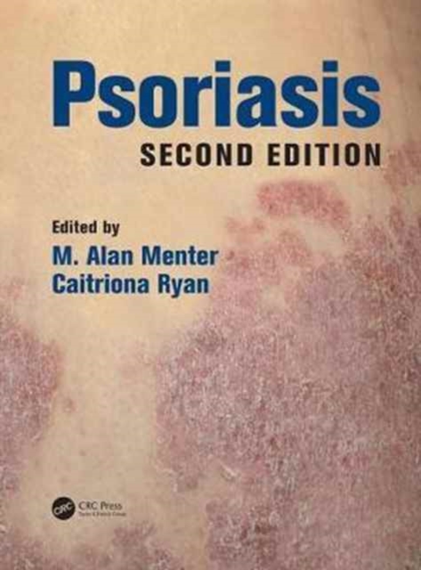 Psoriasis, Hardback Book