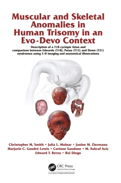 Muscular and Skeletal Anomalies in Human Trisomy in an Evo-Devo Context : Description of a T18 Cyclopic Fetus and Comparison Between Edwards (T18), Patau (T13) and Down (T21) Syndromes Using 3-D Imagi, Hardback Book