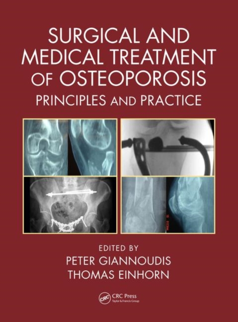 Surgical and Medical Treatment of Osteoporosis : Principles and Practice, Hardback Book