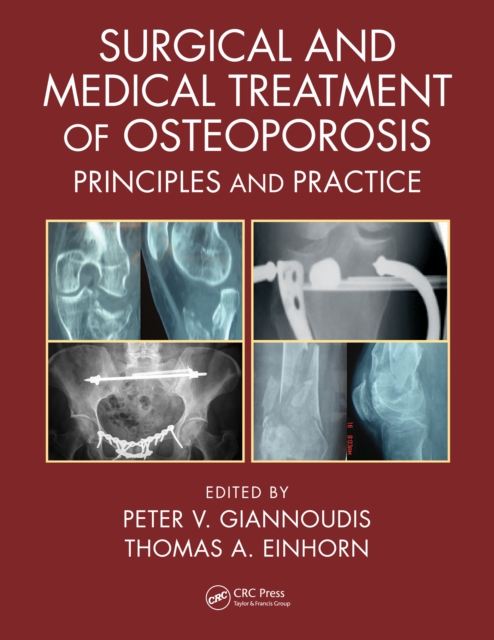 Surgical and Medical Treatment of Osteoporosis : Principles and Practice, PDF eBook