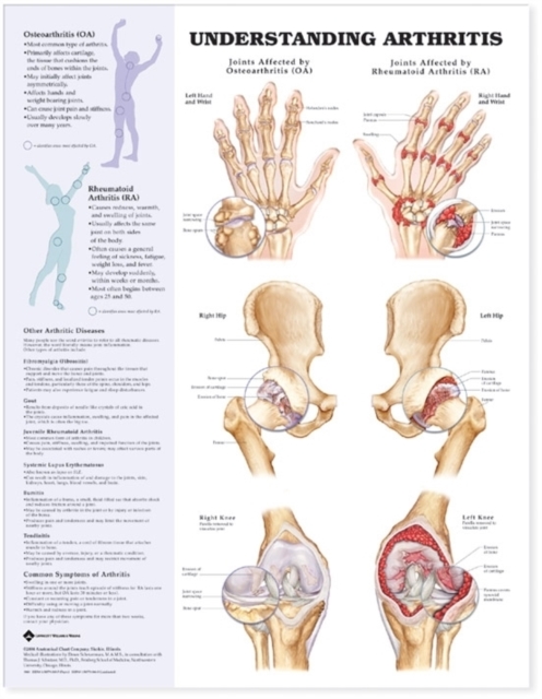Understanding Arthritis Anatomical Chart, Wallchart Book