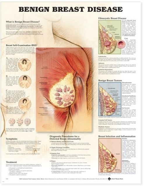 Benign Breast Disease Anatomical Chart, Wallchart Book