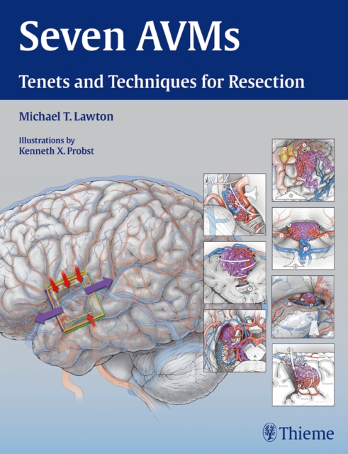 Seven AVMs : Tenets and Techniques for Resection, Hardback Book