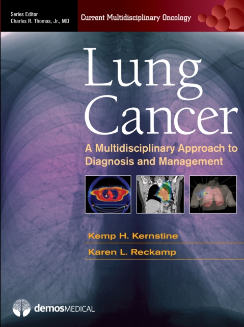 Lung Cancer : A Multidisciplinary Approach to Diagnosis and Management, EPUB eBook