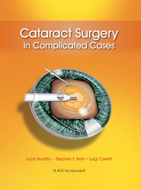 Cataract Surgery in Complicated Cases, PDF eBook