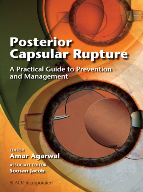 Posterior Capsular Rupture : A Practical Guide to Prevention and Management, PDF eBook