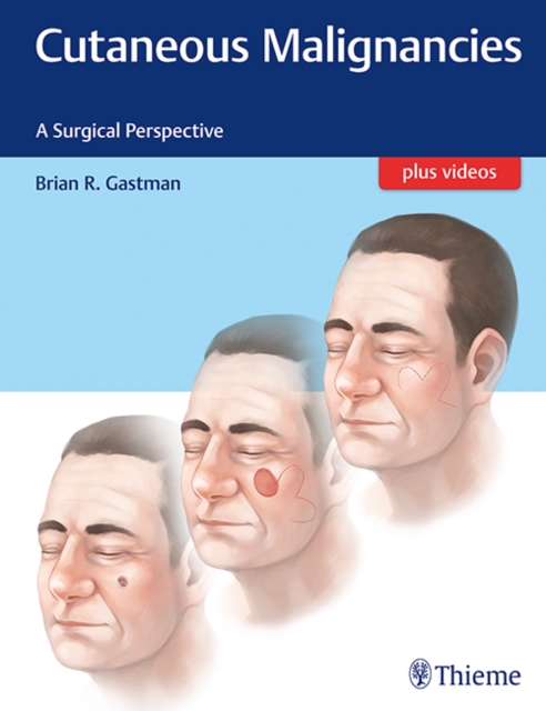 Cutaneous Malignancies : A Surgical Perspective, Mixed media product Book