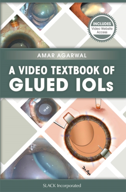 A Video Textbook of Glued IOLs, EPUB eBook