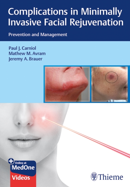 Complications in Minimally Invasive Facial Rejuvenation : Prevention and Management, Mixed media product Book